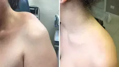 TC25
