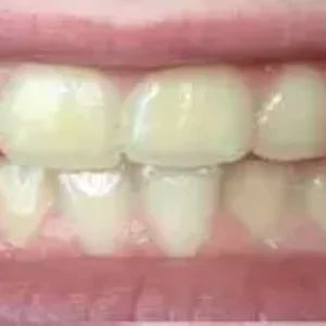 SSA35