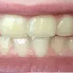 SSA35